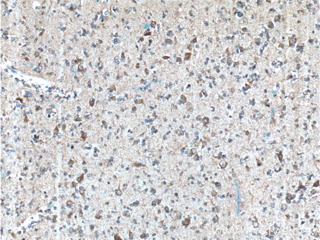 Immunohistochemistry (IHC) staining of human gliomas tissue using ASNS Polyclonal antibody (14681-1-AP)