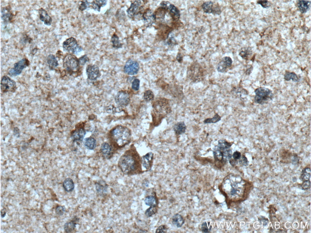Immunohistochemistry (IHC) staining of human gliomas tissue using ASNS Polyclonal antibody (14681-1-AP)