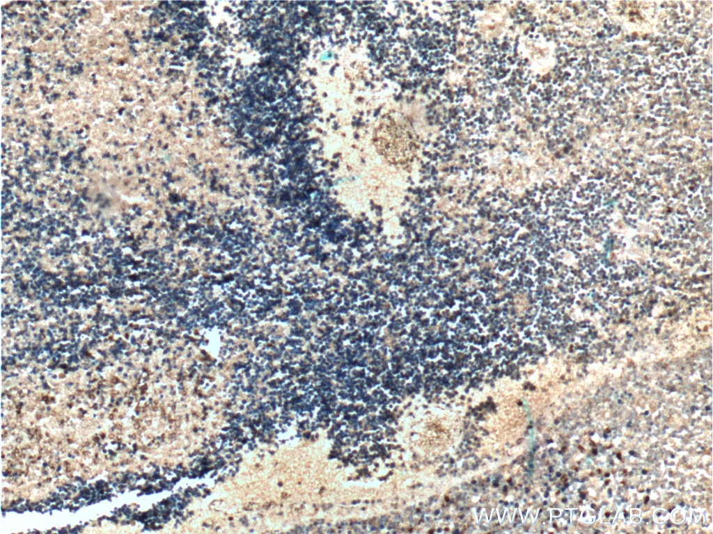 Immunohistochemistry (IHC) staining of human retinoblastoma tissue using ASNS Polyclonal antibody (14681-1-AP)