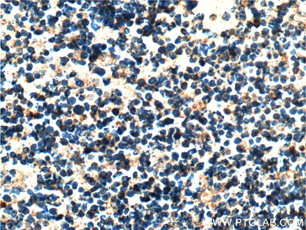 Immunohistochemistry (IHC) staining of human retinoblastoma tissue using ASNS Polyclonal antibody (14681-1-AP)