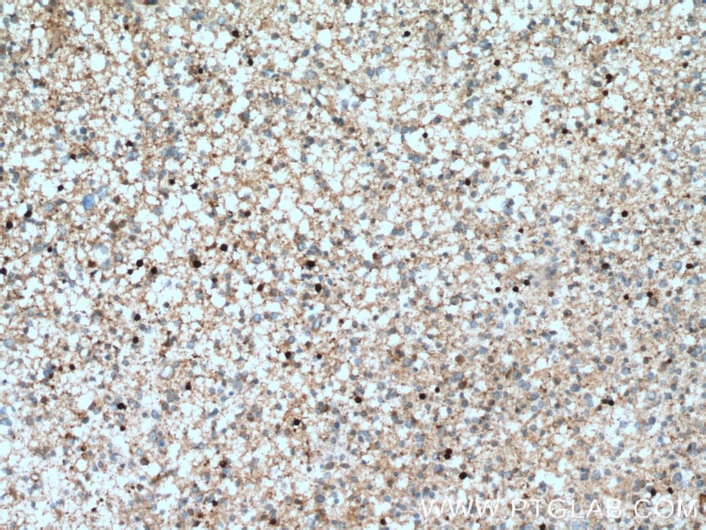 Immunohistochemistry (IHC) staining of human gliomas tissue using ASPA Polyclonal antibody (13244-1-AP)