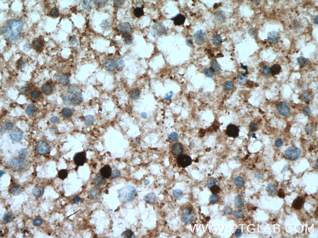 IHC staining of human gliomas using 13244-1-AP
