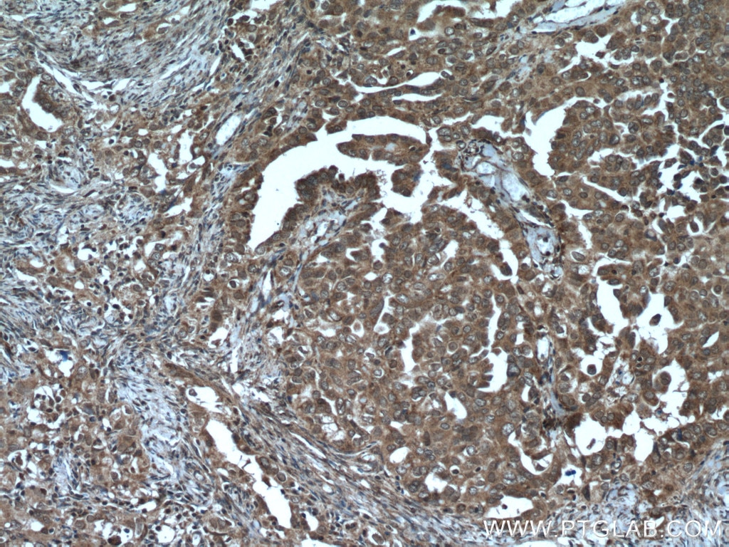 Immunohistochemistry (IHC) staining of human ovary tumor tissue using ASPM Polyclonal antibody (26223-1-AP)