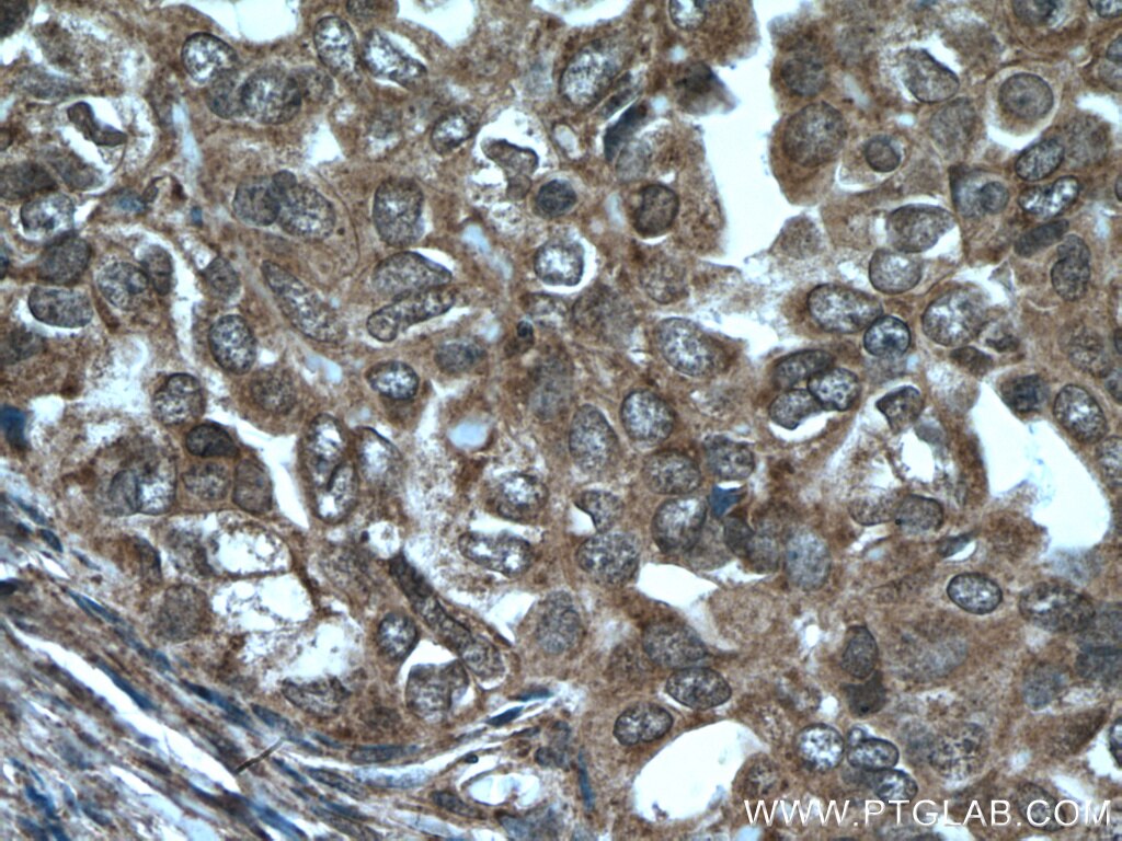 Immunohistochemistry (IHC) staining of human ovary tumor tissue using ASPM Polyclonal antibody (26223-1-AP)