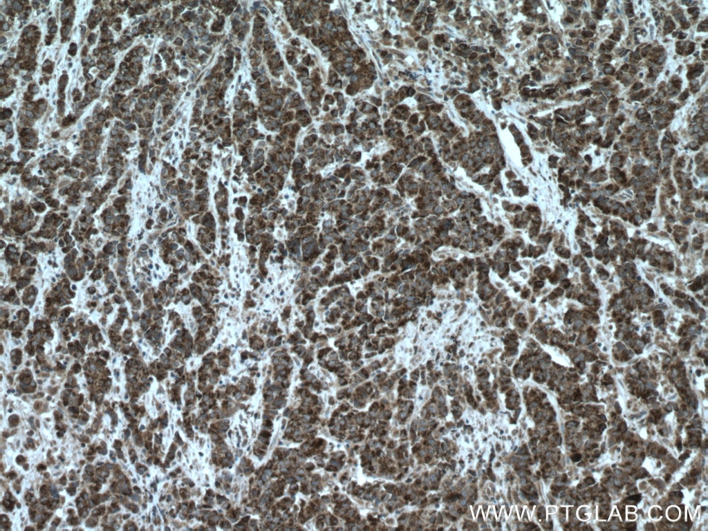 Immunohistochemistry (IHC) staining of human prostate cancer tissue using ASPM Polyclonal antibody (26223-1-AP)