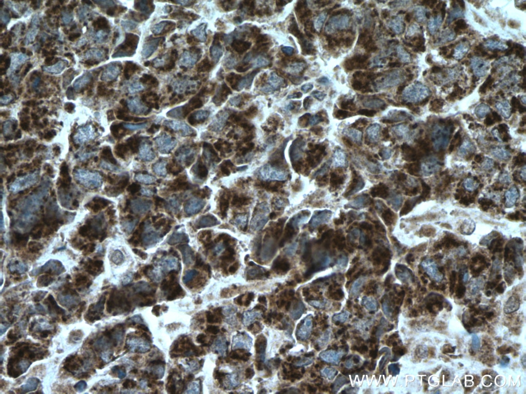 Immunohistochemistry (IHC) staining of human prostate cancer tissue using ASPM Polyclonal antibody (26223-1-AP)