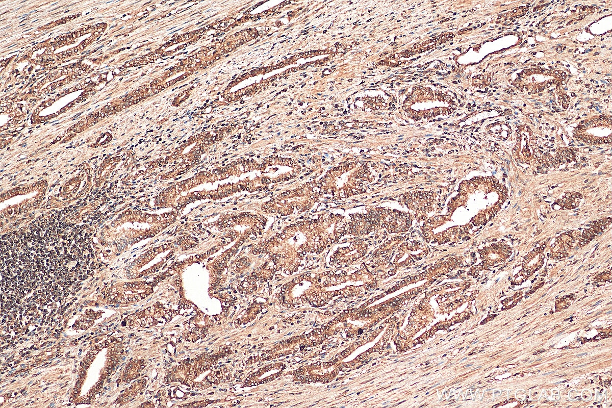 Immunohistochemistry (IHC) staining of human prostate cancer tissue using ASPM Polyclonal antibody (26223-1-AP)