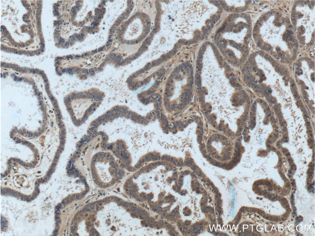 Immunohistochemistry (IHC) staining of human ovary tumor tissue using ASPM Polyclonal antibody (26223-1-AP)