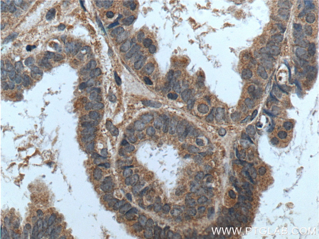 Immunohistochemistry (IHC) staining of human ovary tumor tissue using ASPM Polyclonal antibody (26223-1-AP)