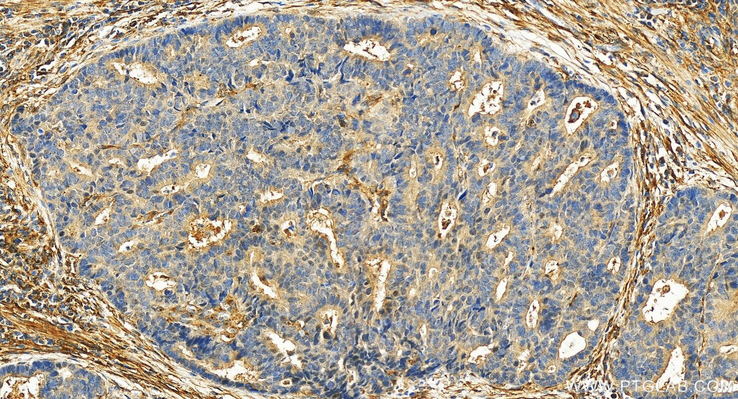 Immunohistochemistry (IHC) staining of human stomach cancer tissue using ASPN Polyclonal antibody (27602-1-AP)