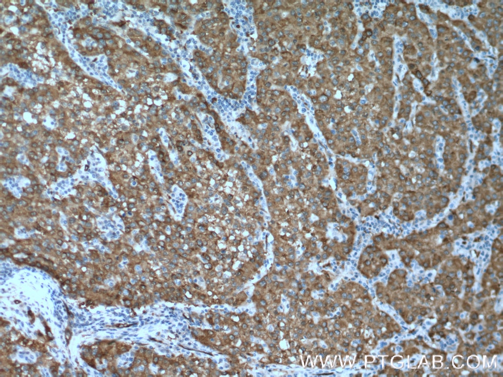 Immunohistochemistry (IHC) staining of human liver cancer tissue using ASS1 Polyclonal antibody (16210-1-AP)