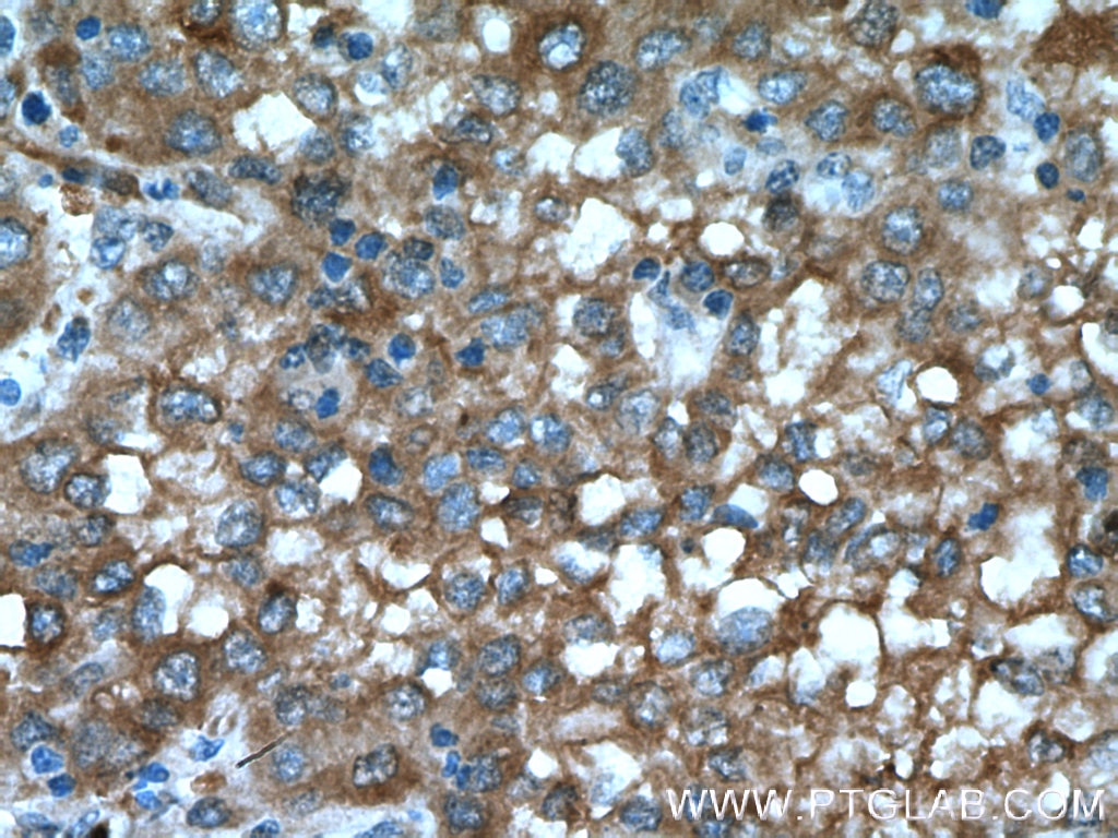 Immunohistochemistry (IHC) staining of human liver cancer tissue using ASS1 Polyclonal antibody (16210-1-AP)