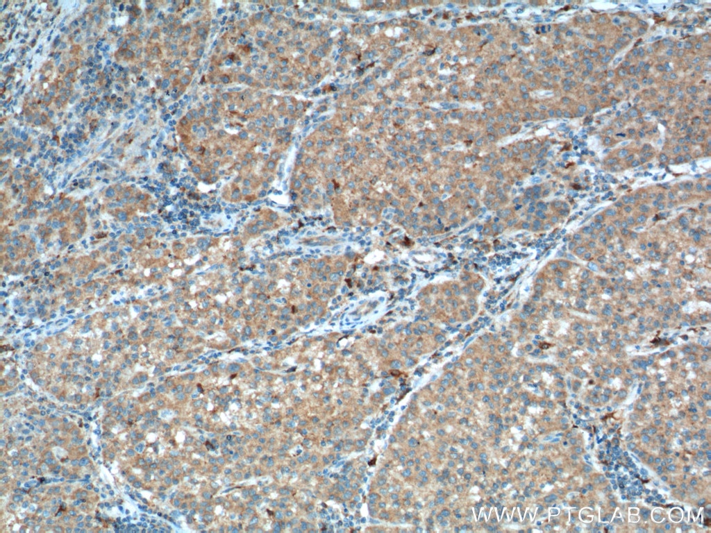 Immunohistochemistry (IHC) staining of human liver cancer tissue using ASS1 Monoclonal antibody (66036-1-Ig)