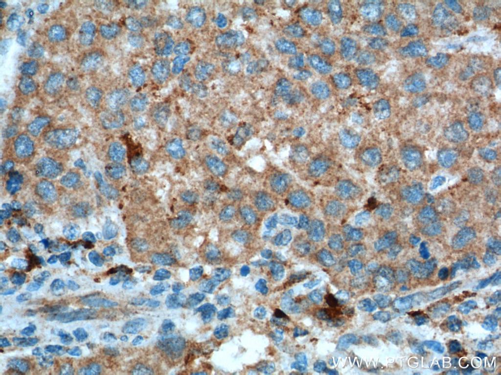 Immunohistochemistry (IHC) staining of human liver cancer tissue using ASS1 Monoclonal antibody (66036-1-Ig)