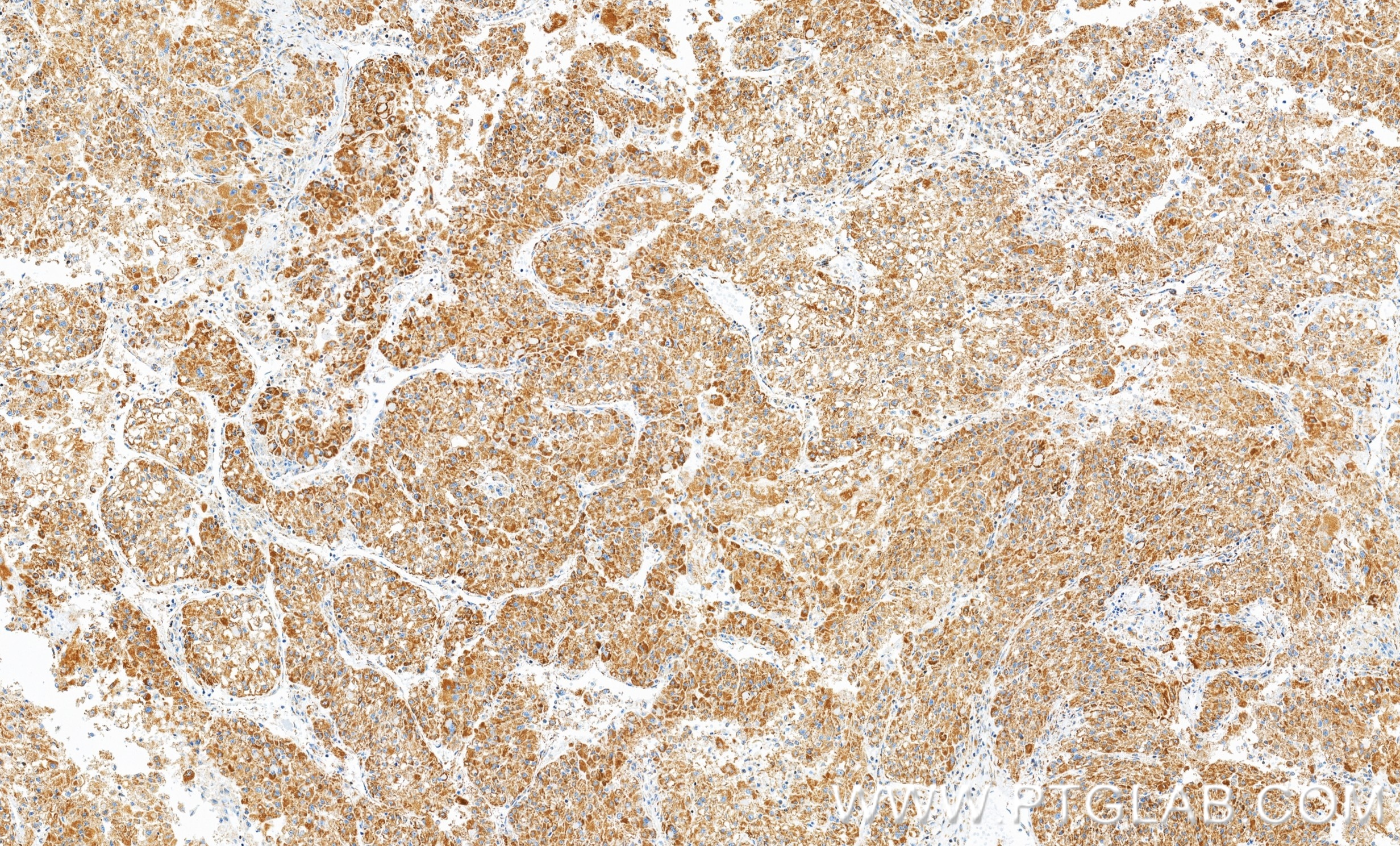 Immunohistochemistry (IHC) staining of human liver cancer tissue using ATAD3A/B Recombinant monoclonal antibody (86461-2-RR)