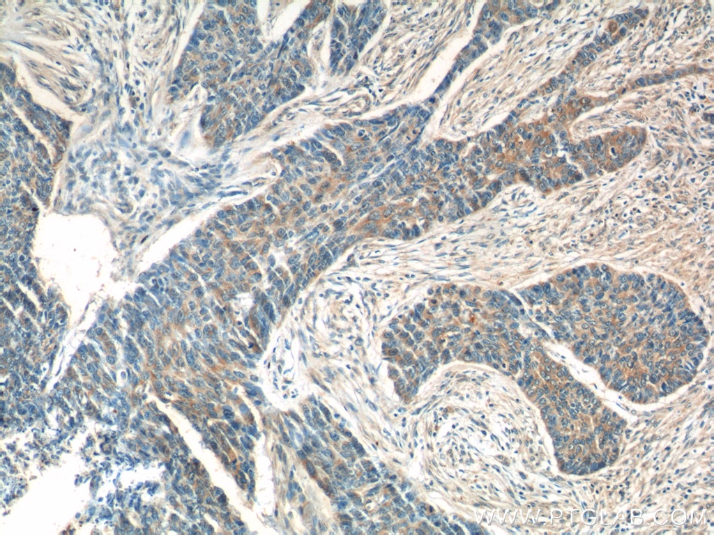 Immunohistochemistry (IHC) staining of human skin cancer tissue using ATAD3A/B Polyclonal antibody (16610-1-AP)