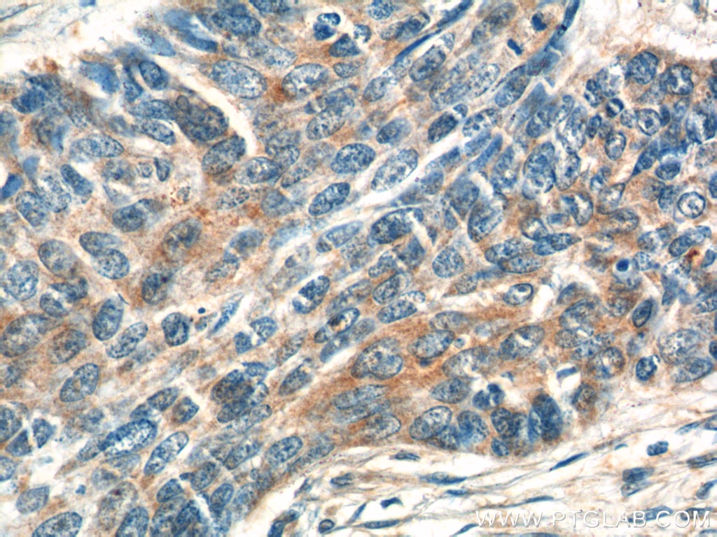 Immunohistochemistry (IHC) staining of human skin cancer tissue using ATAD3A/B Polyclonal antibody (16610-1-AP)