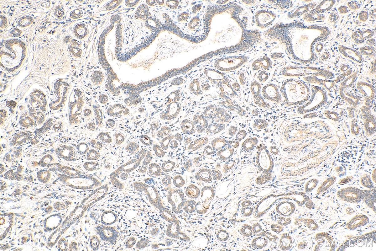 Immunohistochemistry (IHC) staining of human breast cancer tissue using ATF2-Specific Polyclonal antibody (14834-1-AP)