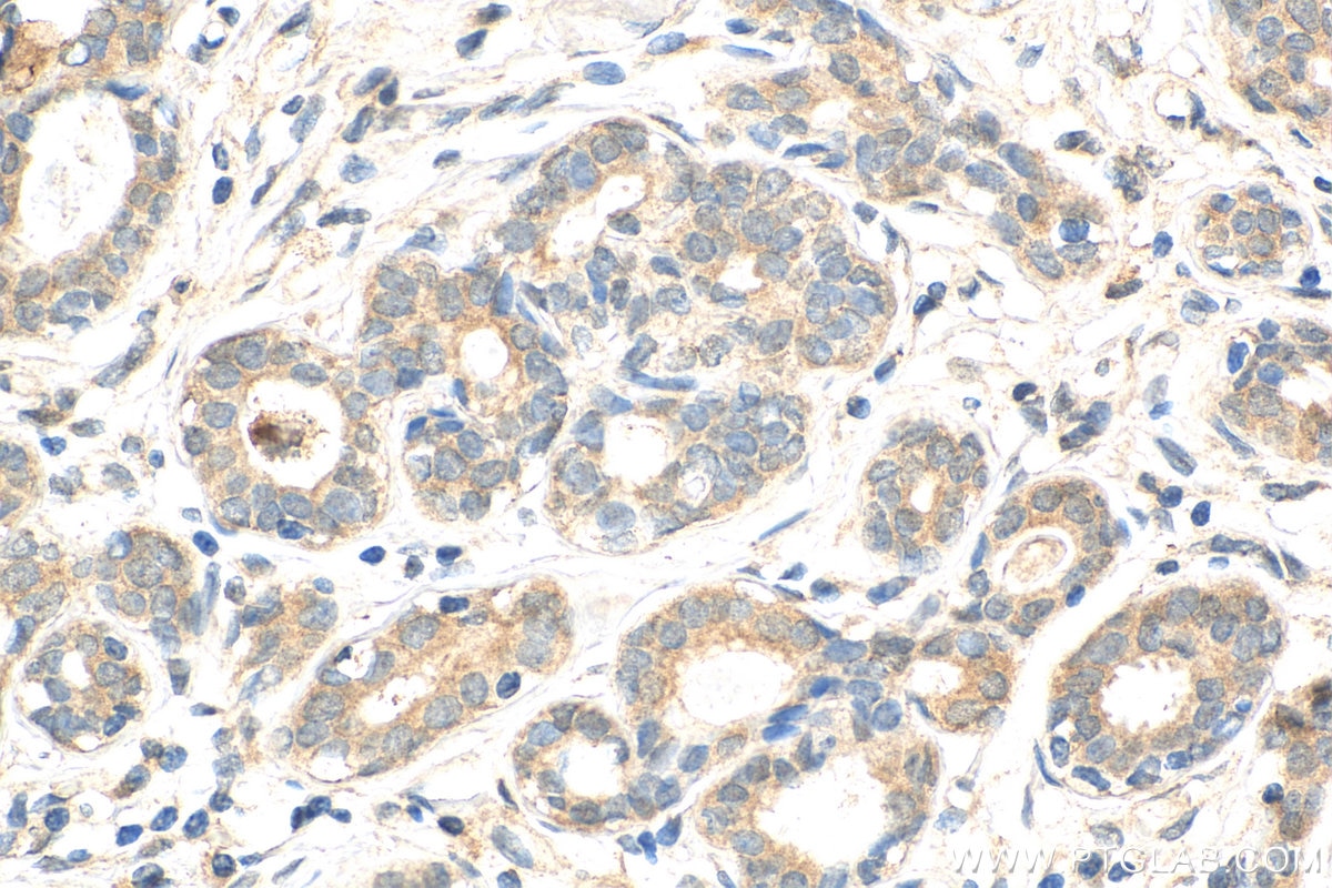 Immunohistochemistry (IHC) staining of human breast cancer tissue using ATF2-Specific Polyclonal antibody (14834-1-AP)