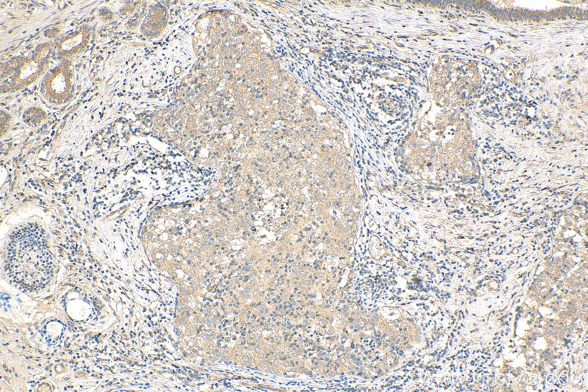 Immunohistochemistry (IHC) staining of human breast cancer tissue using ATF2-Specific Polyclonal antibody (14834-1-AP)