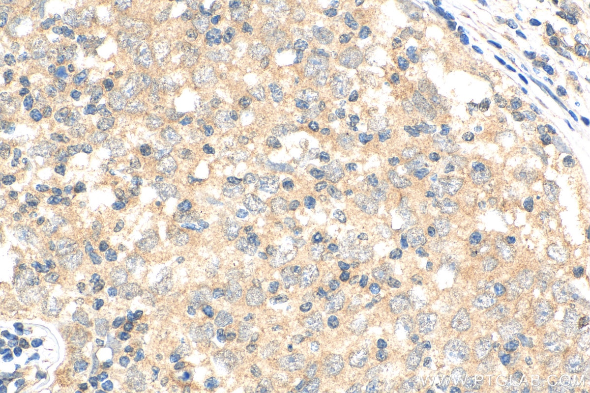Immunohistochemistry (IHC) staining of human breast cancer tissue using ATF2-Specific Polyclonal antibody (14834-1-AP)