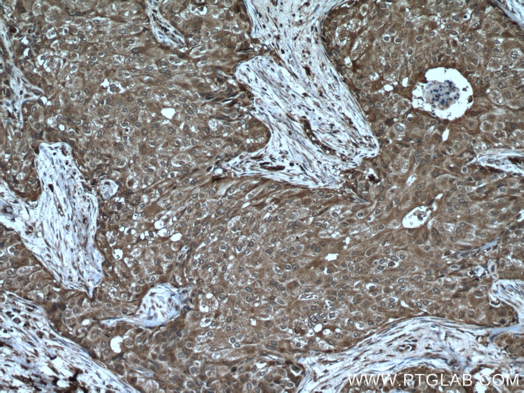 Immunohistochemistry (IHC) staining of human breast cancer tissue using ATF4 Polyclonal antibody (10835-1-AP)