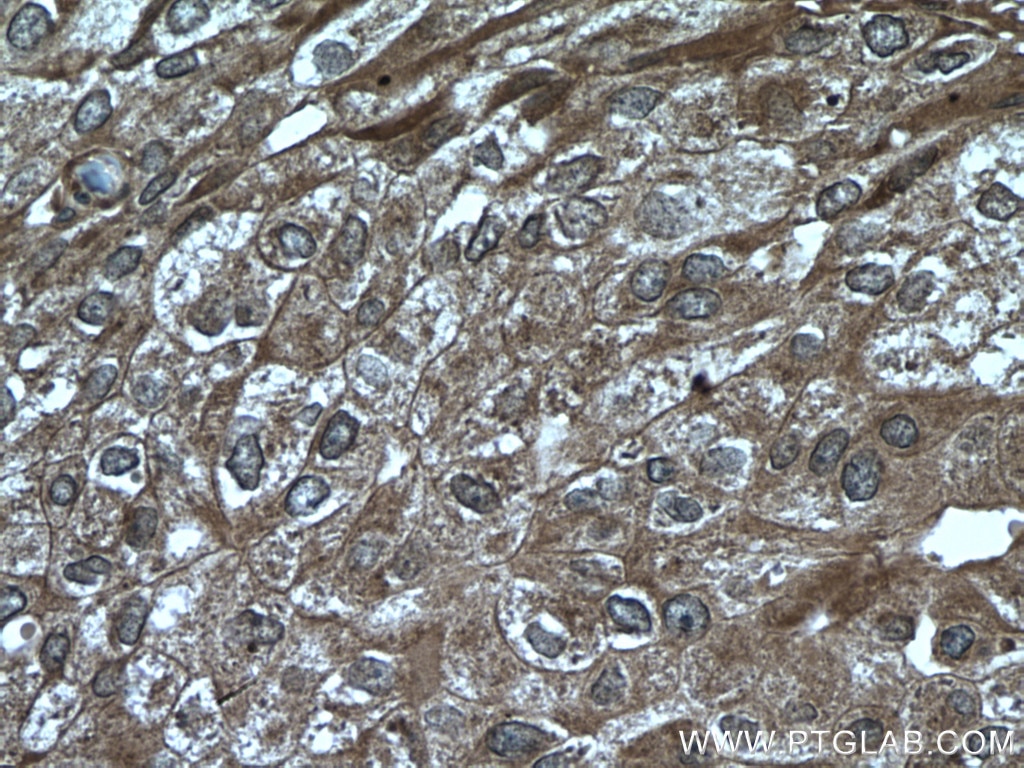 Immunohistochemistry (IHC) staining of human breast cancer tissue using ATF4 Polyclonal antibody (10835-1-AP)