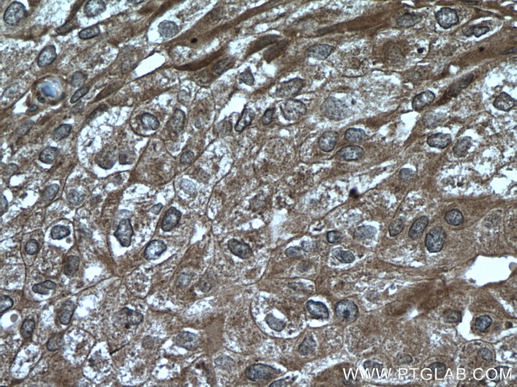 IHC staining of human breast cancer using 10835-1-AP