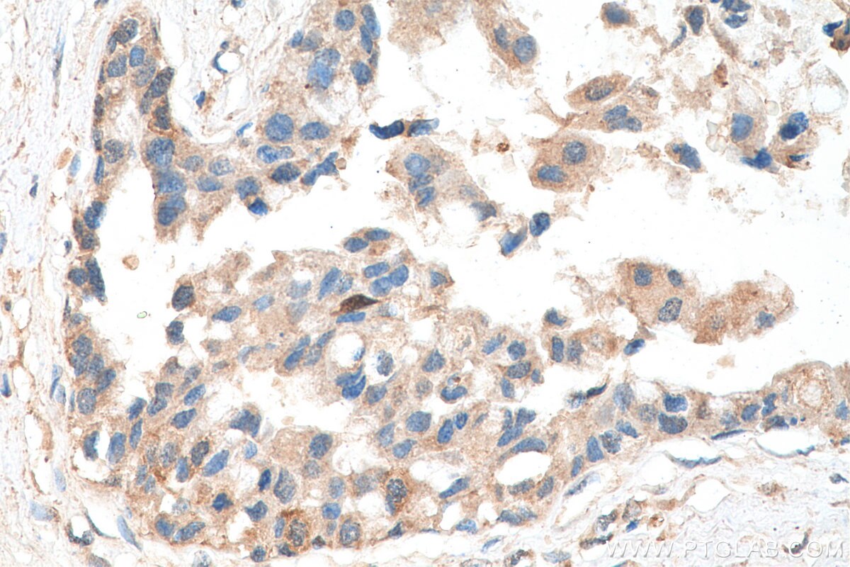 Immunohistochemistry (IHC) staining of human breast cancer tissue using ATF4 Polyclonal antibody (28657-1-AP)