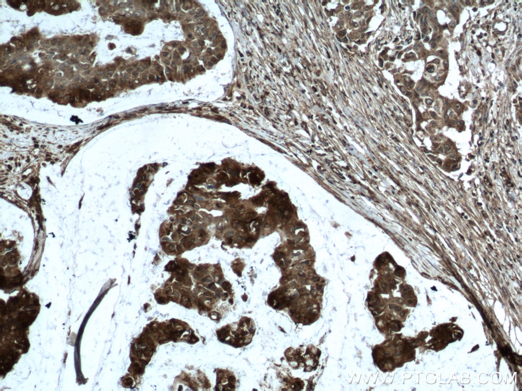 Immunohistochemistry (IHC) staining of human breast cancer tissue using ATF4 Monoclonal antibody (60035-1-Ig)