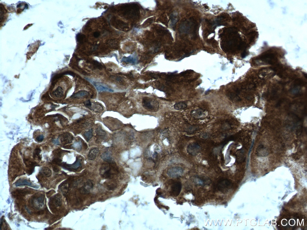 Immunohistochemistry (IHC) staining of human breast cancer tissue using ATF4 Monoclonal antibody (60035-1-Ig)