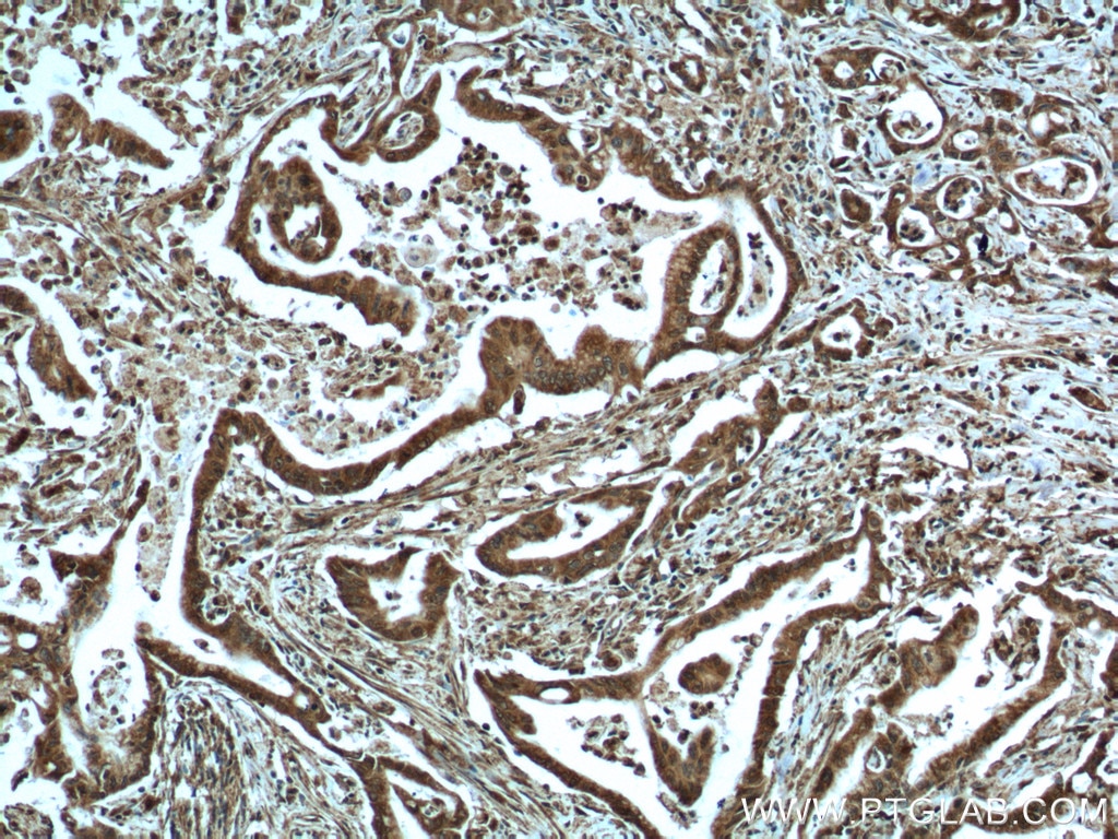 IHC staining of human pancreas cancer using 60035-1-Ig