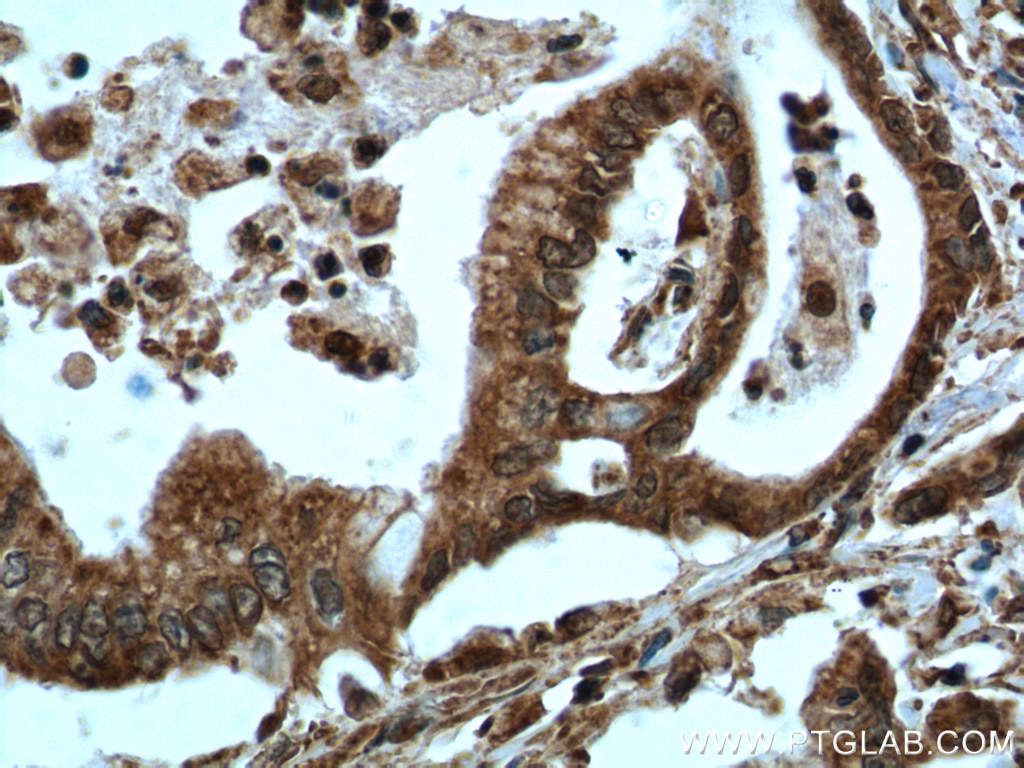 IHC staining of human pancreas cancer using 60035-1-Ig