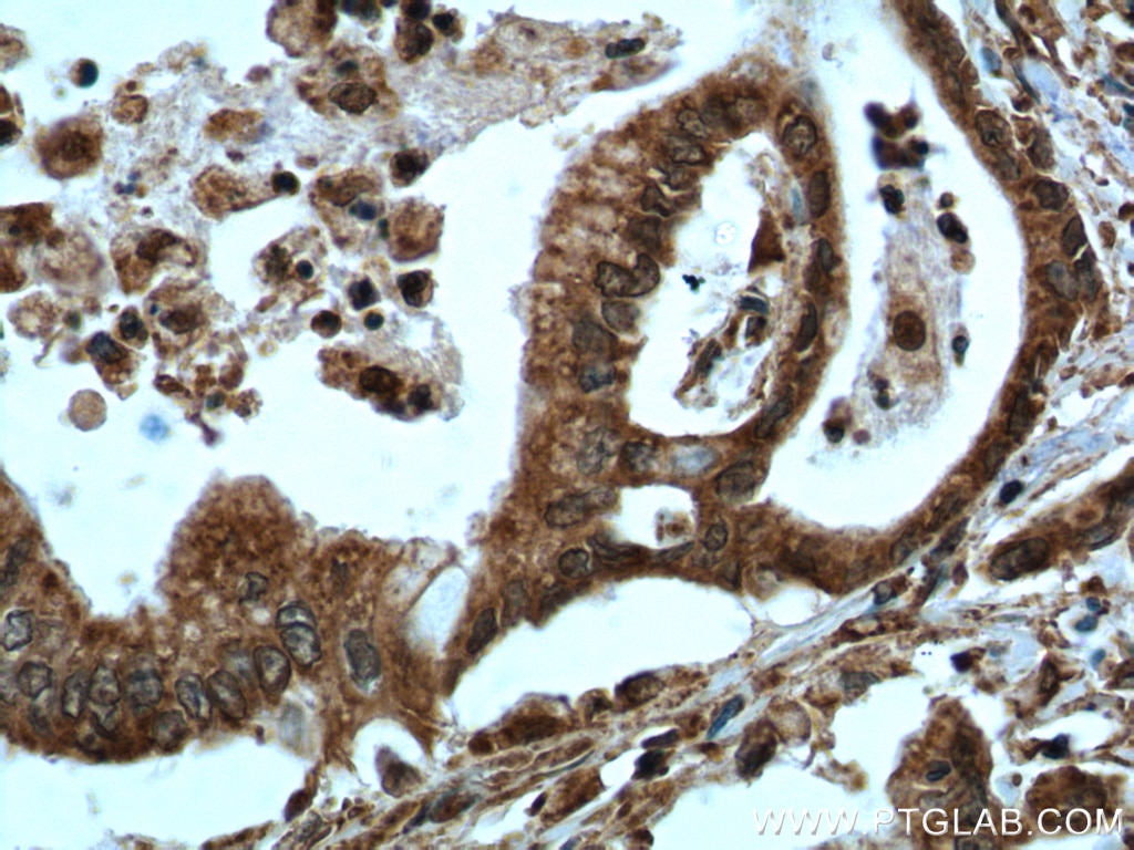 Immunohistochemistry (IHC) staining of human pancreas cancer tissue using ATF4 Monoclonal antibody (60035-1-Ig)