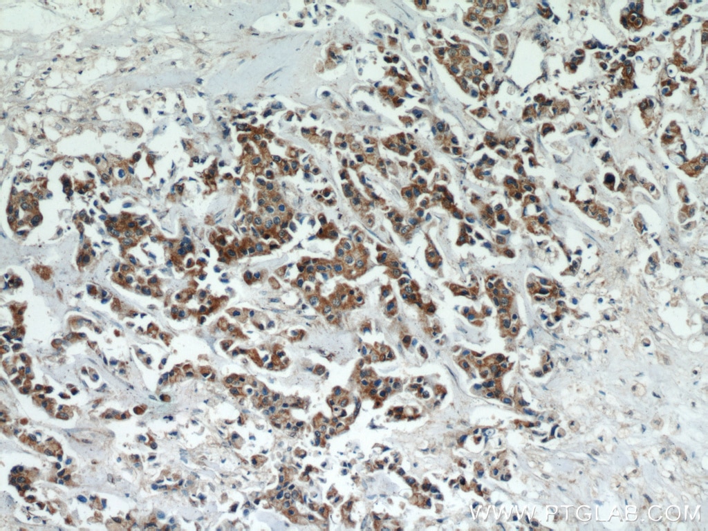 Immunohistochemistry (IHC) staining of human breast cancer tissue using ATF4 Monoclonal antibody (60035-1-Ig)