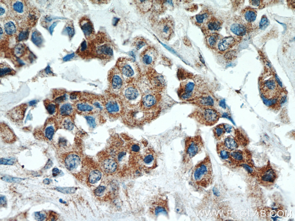 Immunohistochemistry (IHC) staining of human breast cancer tissue using ATF4 Monoclonal antibody (60035-1-Ig)