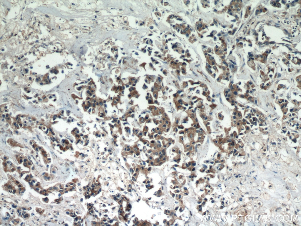 Immunohistochemistry (IHC) staining of human breast cancer tissue using ATF4 Monoclonal antibody (60035-1-Ig)