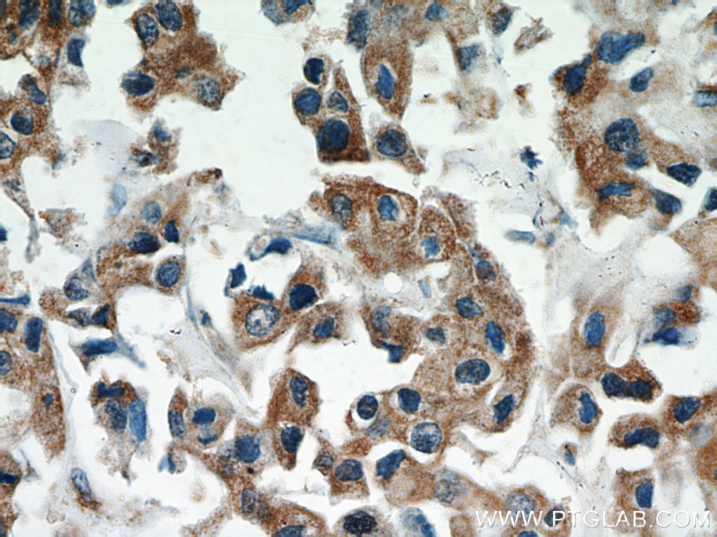 Immunohistochemistry (IHC) staining of human breast cancer tissue using ATF4 Monoclonal antibody (60035-1-Ig)