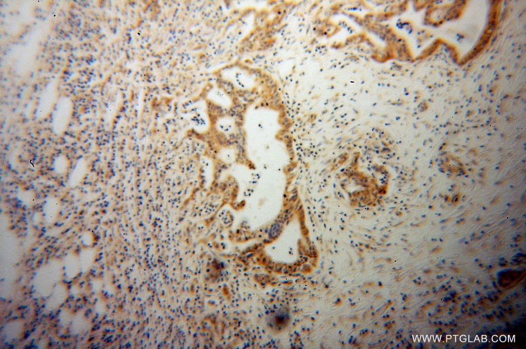Immunohistochemistry (IHC) staining of human pancreas cancer tissue using ATF4 Monoclonal antibody (60035-1-Ig)