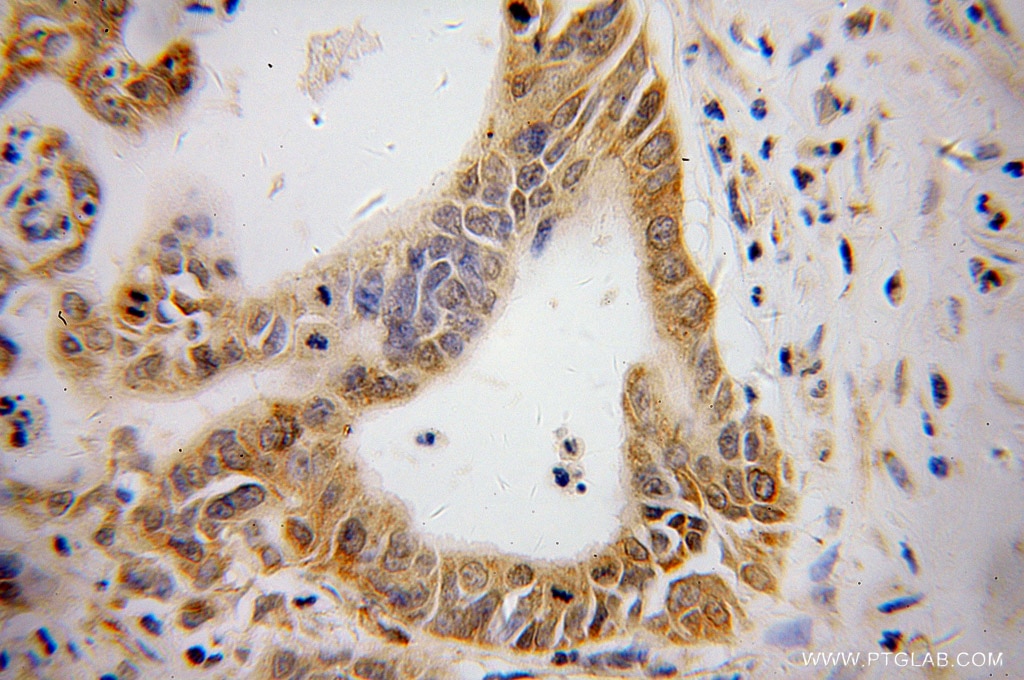 Immunohistochemistry (IHC) staining of human pancreas cancer tissue using ATF4 Monoclonal antibody (60035-1-Ig)