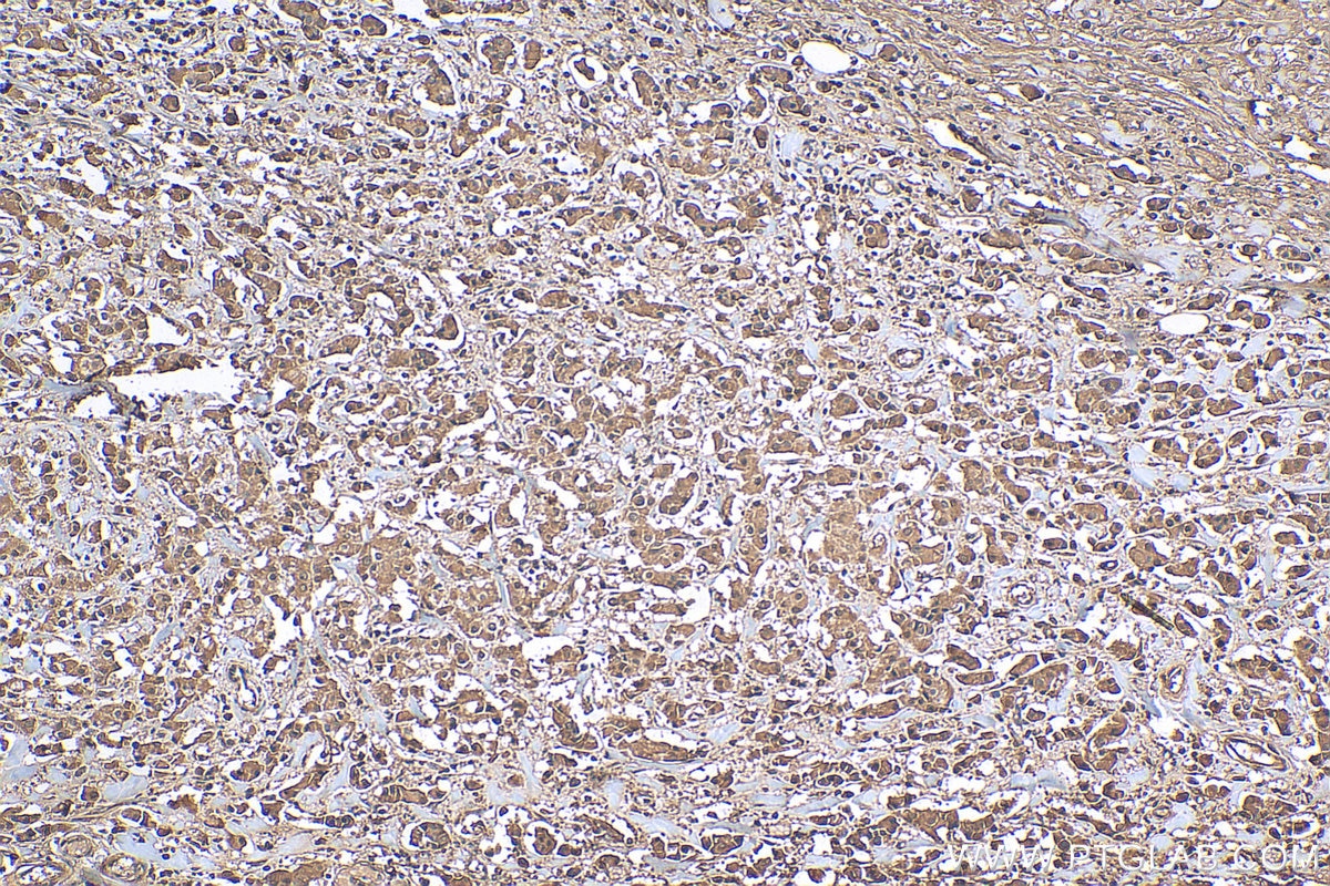 Immunohistochemistry (IHC) staining of human breast cancer tissue using ATF4 Recombinant antibody (81798-1-RR)