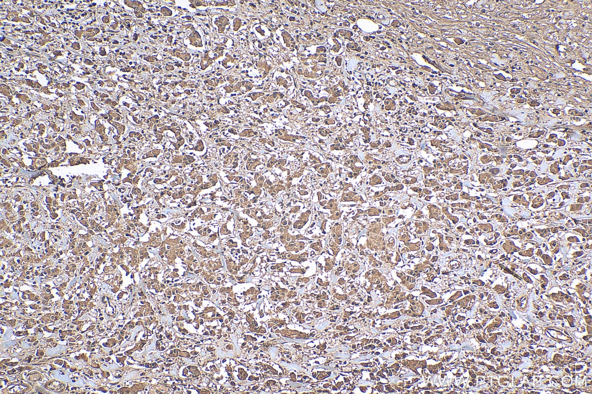 IHC staining of human breast cancer using 81798-1-RR