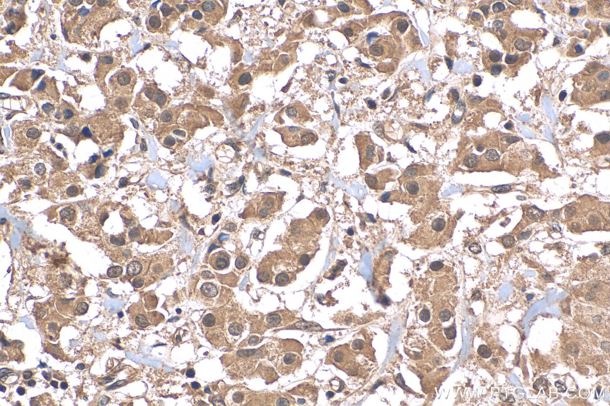 IHC staining of human breast cancer using 81798-1-RR