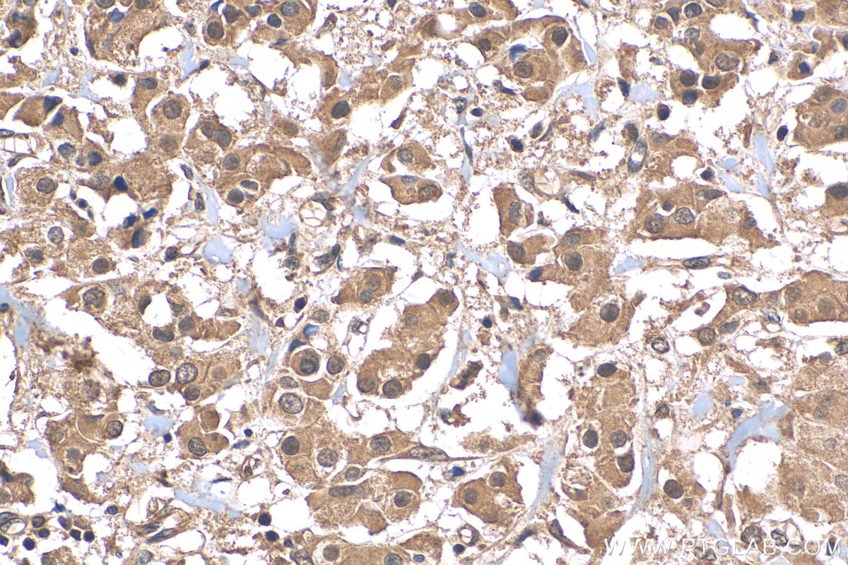 Immunohistochemistry (IHC) staining of human breast cancer tissue using ATF4 Recombinant antibody (81798-1-RR)