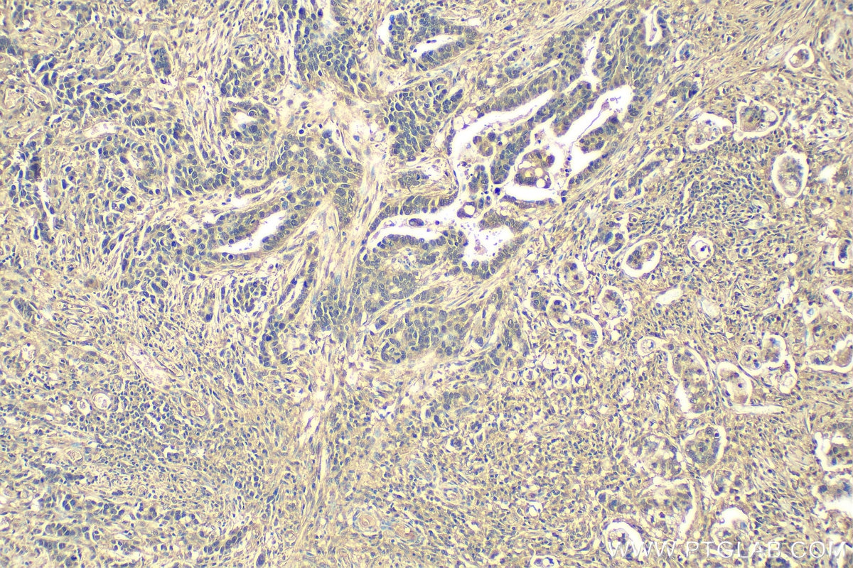 Immunohistochemistry (IHC) staining of human stomach cancer tissue using ATF4 Recombinant antibody (81798-1-RR)