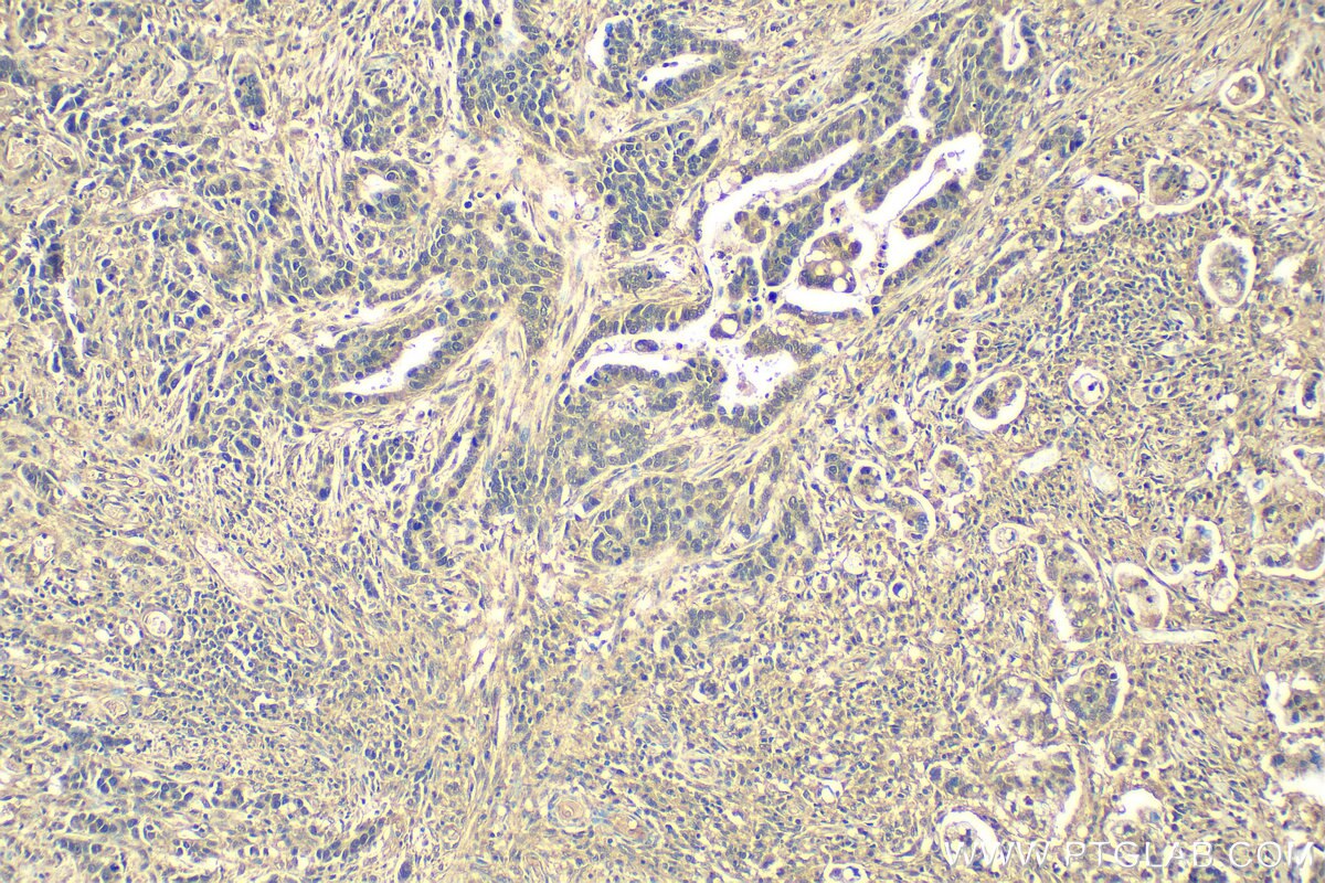 Immunohistochemistry (IHC) staining of human stomach cancer tissue using ATF4 Recombinant antibody (81798-1-RR)