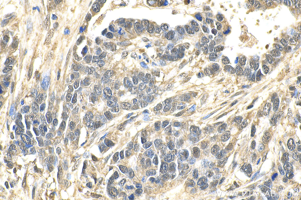 IHC staining of human stomach cancer using 81798-1-RR