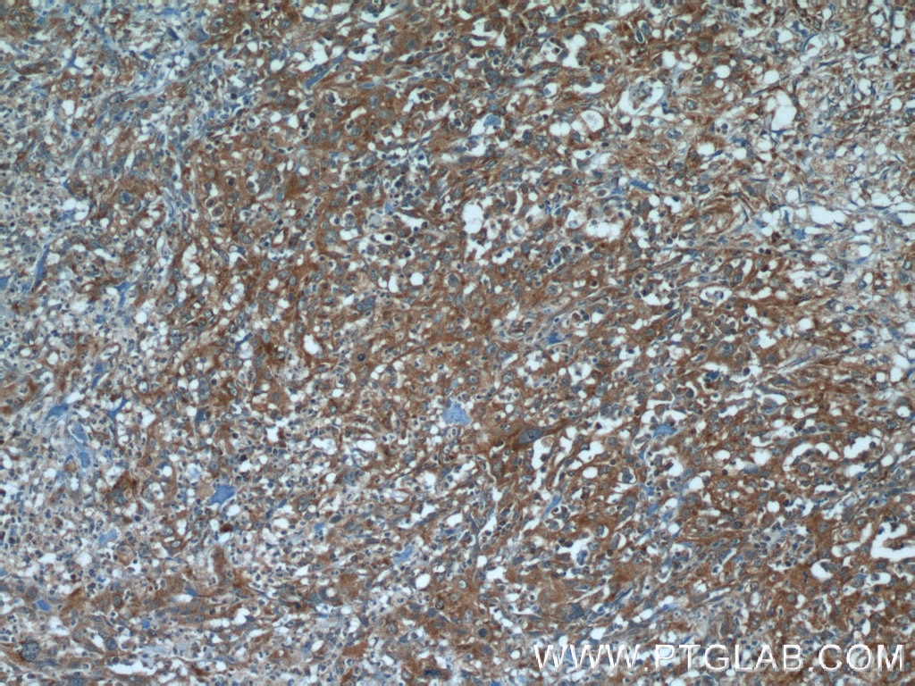 Immunohistochemistry (IHC) staining of human cervical cancer tissue using ATF6 Polyclonal antibody (24169-1-AP)