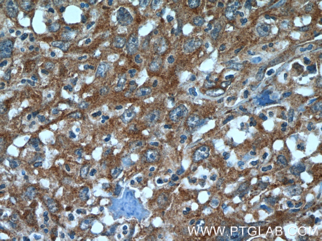 Immunohistochemistry (IHC) staining of human cervical cancer tissue using ATF6 Polyclonal antibody (24169-1-AP)