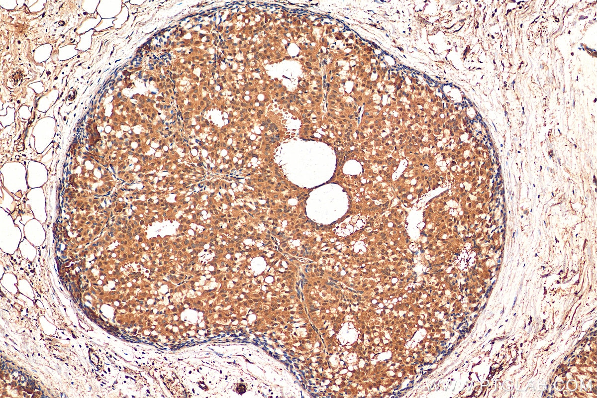 IHC staining of human breast hyperplasia using 24169-1-AP